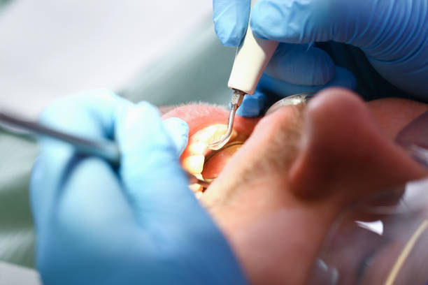 Best Emergency Wisdom Teeth Removal in Trinity, FL
