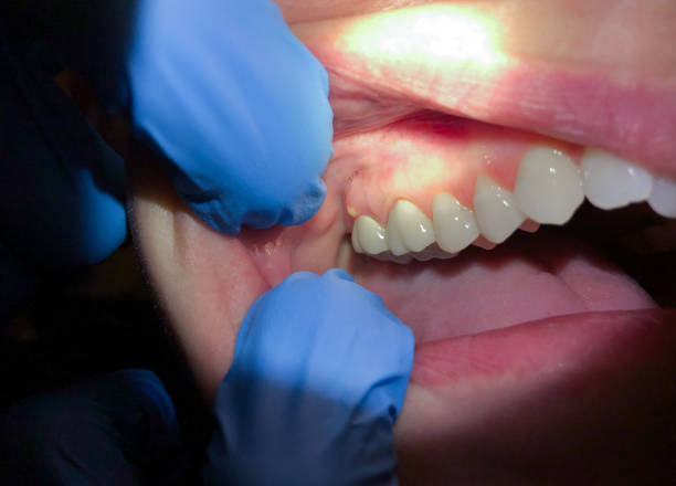 Best Emergency Tooth Extraction in Trinity, FL